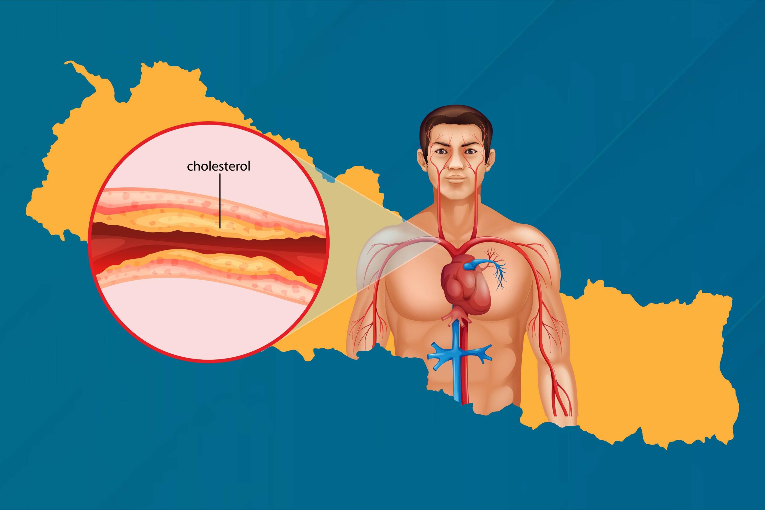 The Rising Problem of High Cholesterol in Nepal: Causes and Solutions